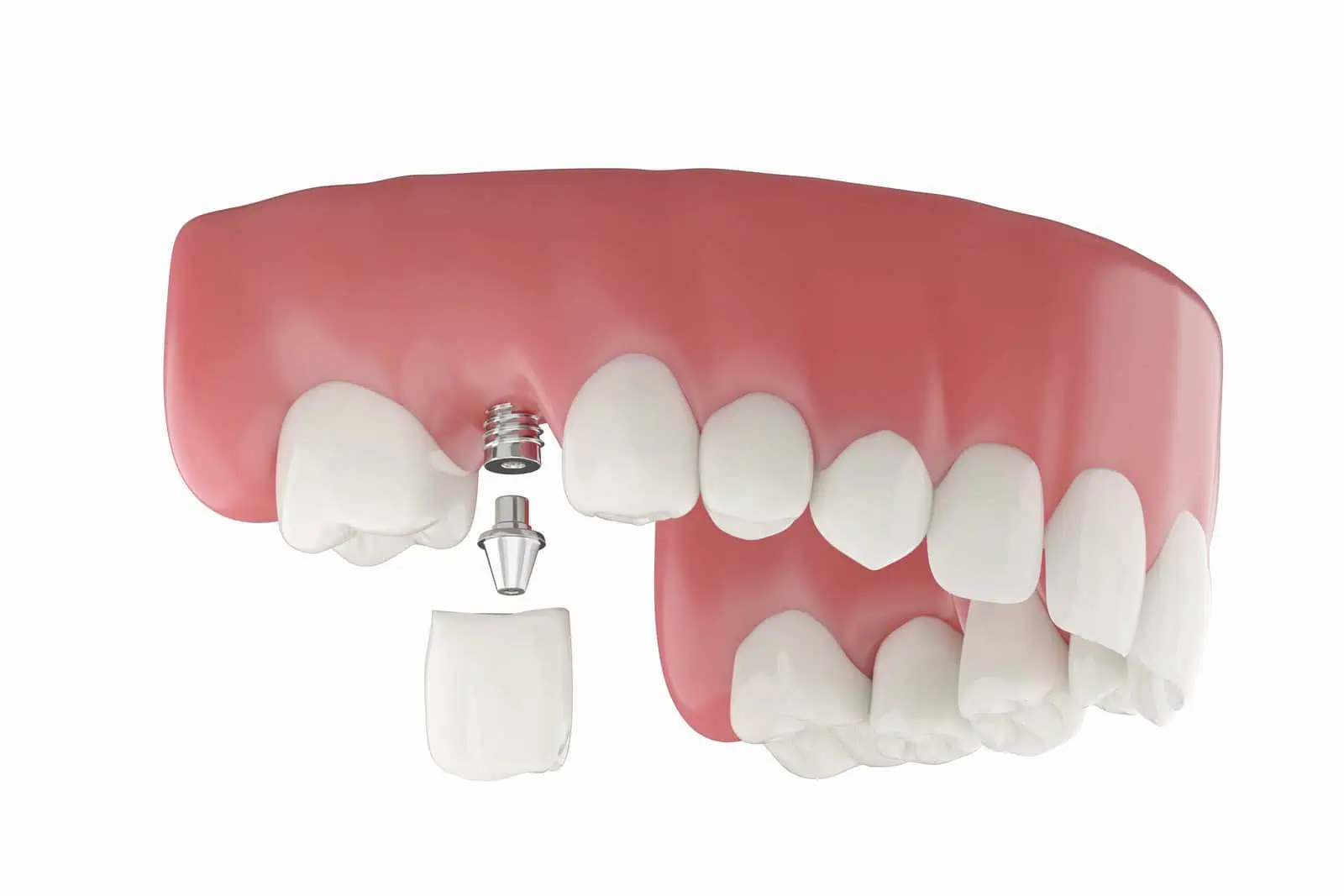 Close-up illustration of a single dental implant